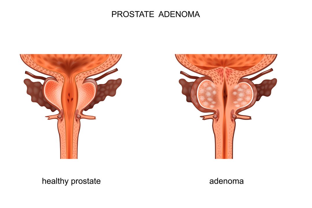 Zdravá prostata a adenom