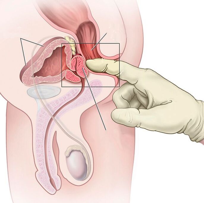 Masáž prostaty pro léčbu prostatitidy