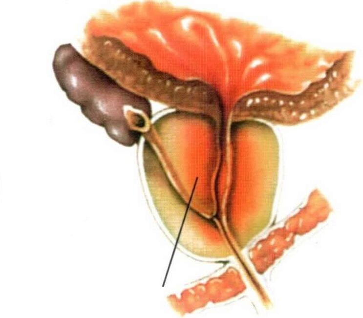 Zánět tkáně prostaty u chronické prostatitidy